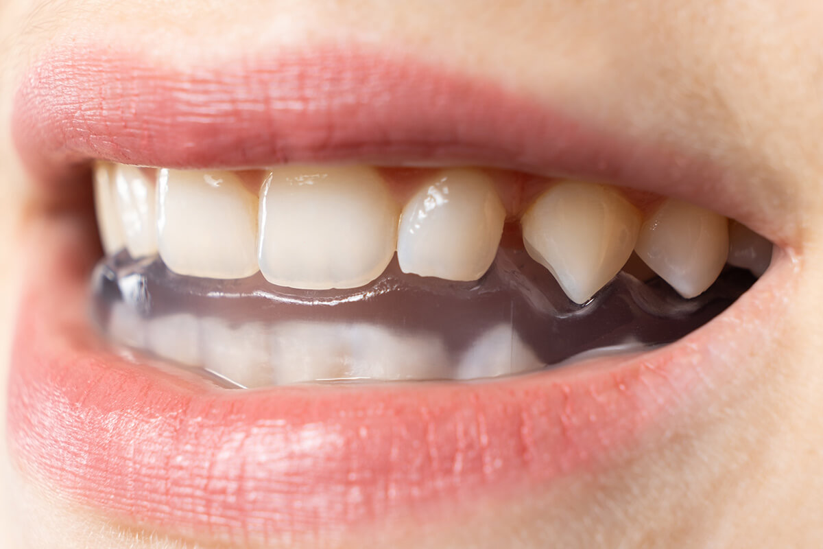 Effective-Strategies-for-Reducing-Teeth-Grinding
