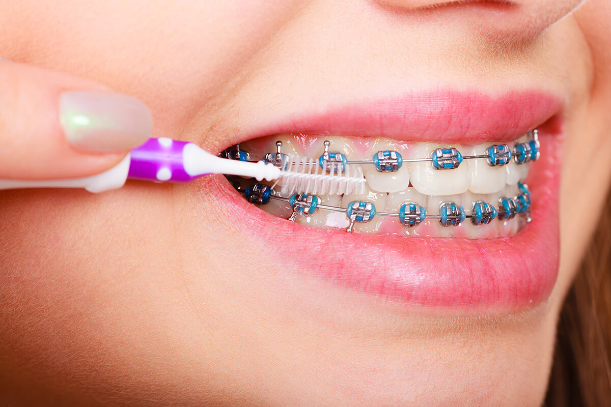 Regularly-brush-your-braces-to-remove-stuck-food-particles