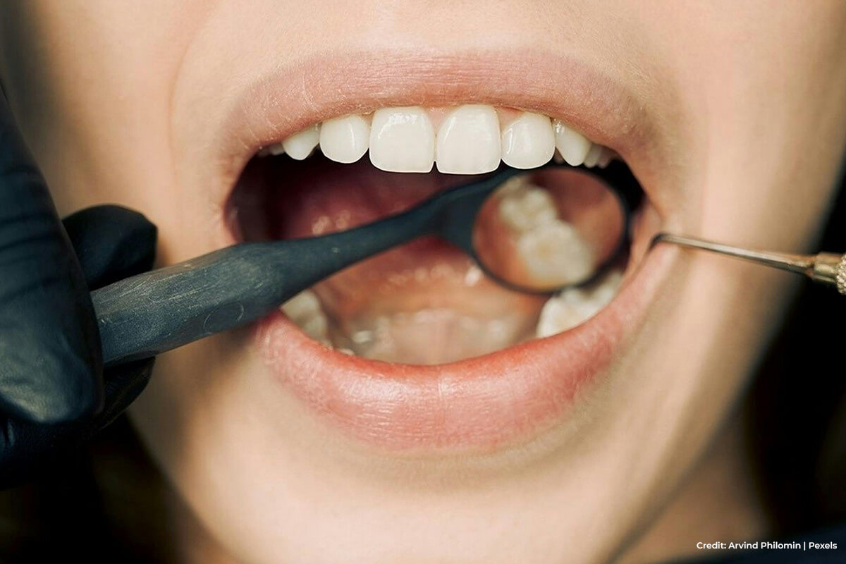 Routine-cleaning-keeps-dental-crowns-in-tiptop-shape