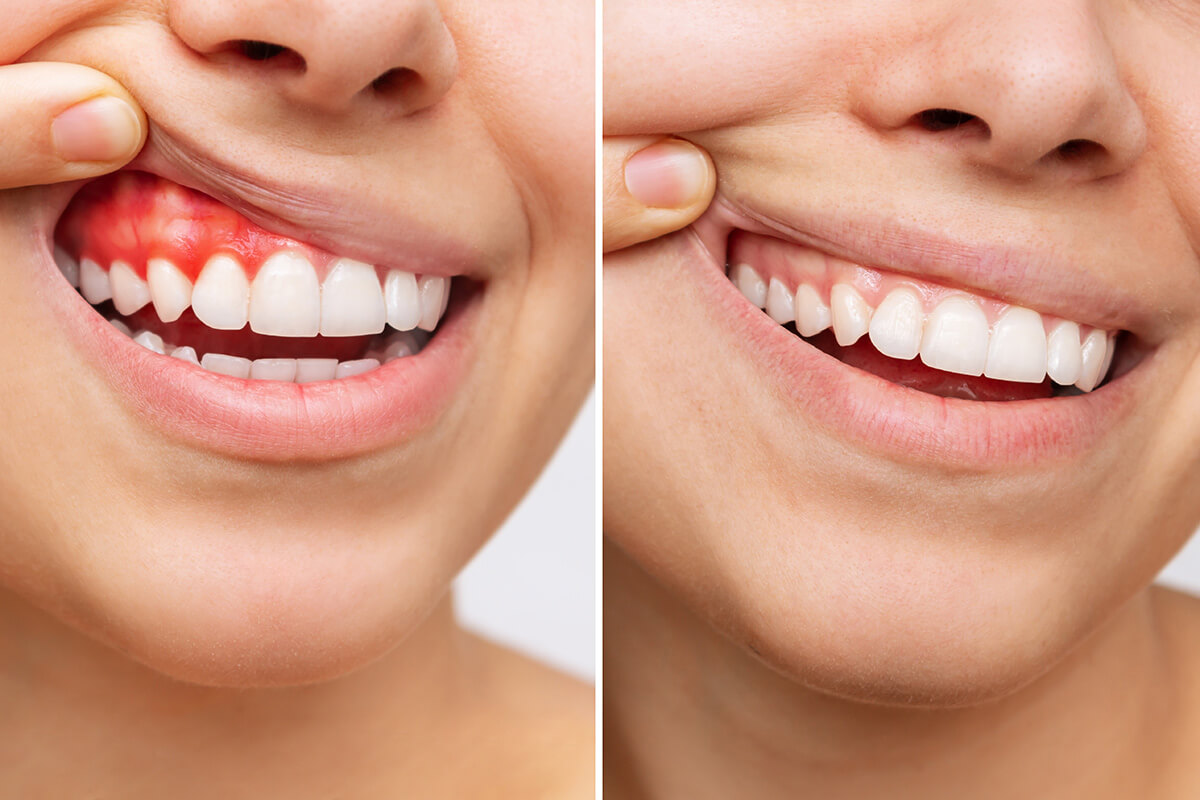 When-is-Gum-Tissue-Grafting-Necessary