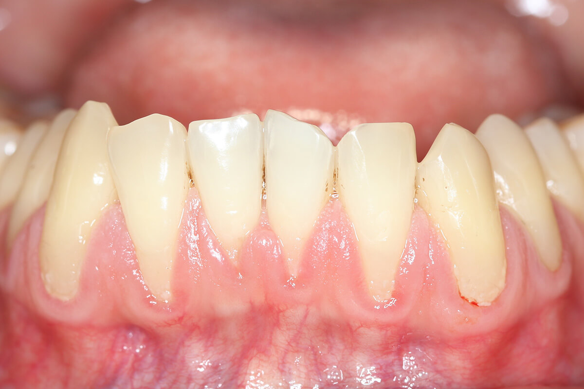 When-is-Gum-Tissue-Grafting-Recommended