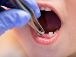A-Gentle-Guide-to-Baby-Tooth-Extraction