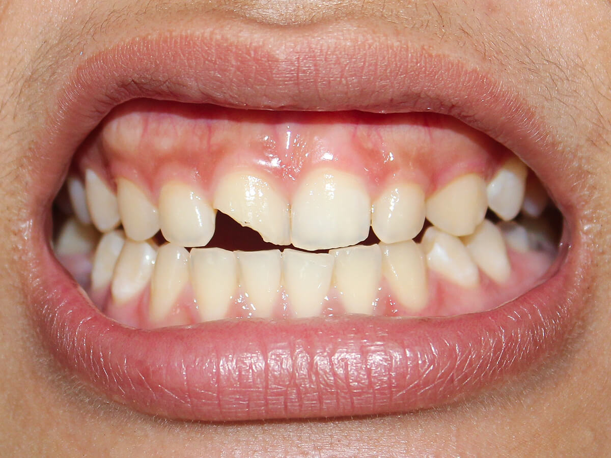 Chipped-Tooth-First-Aid-What-to-Do-Immediately