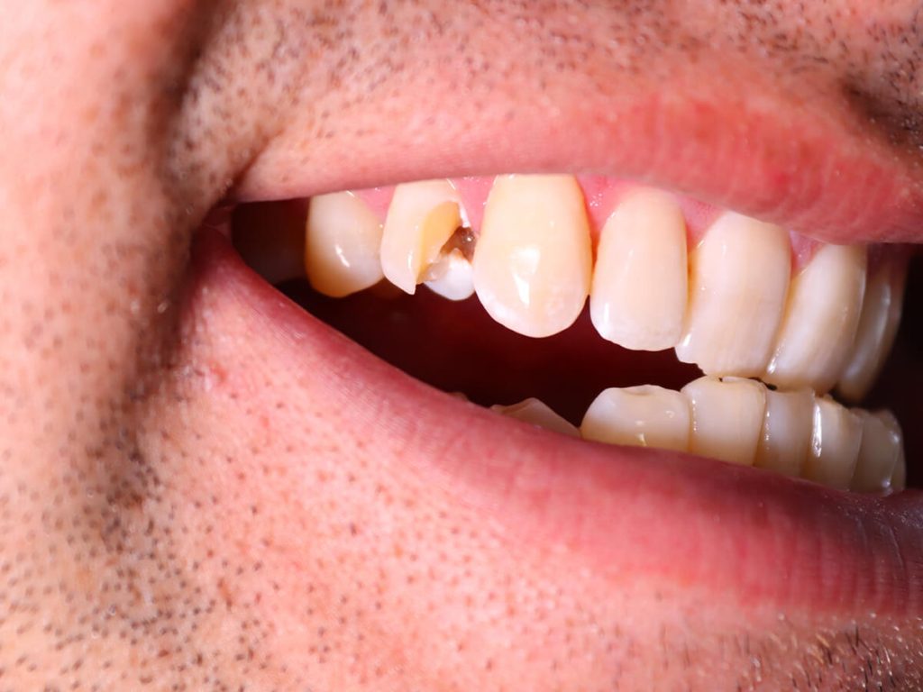 Common-Dental-Injuries-in-Sports-and-What-to-Do-About-it