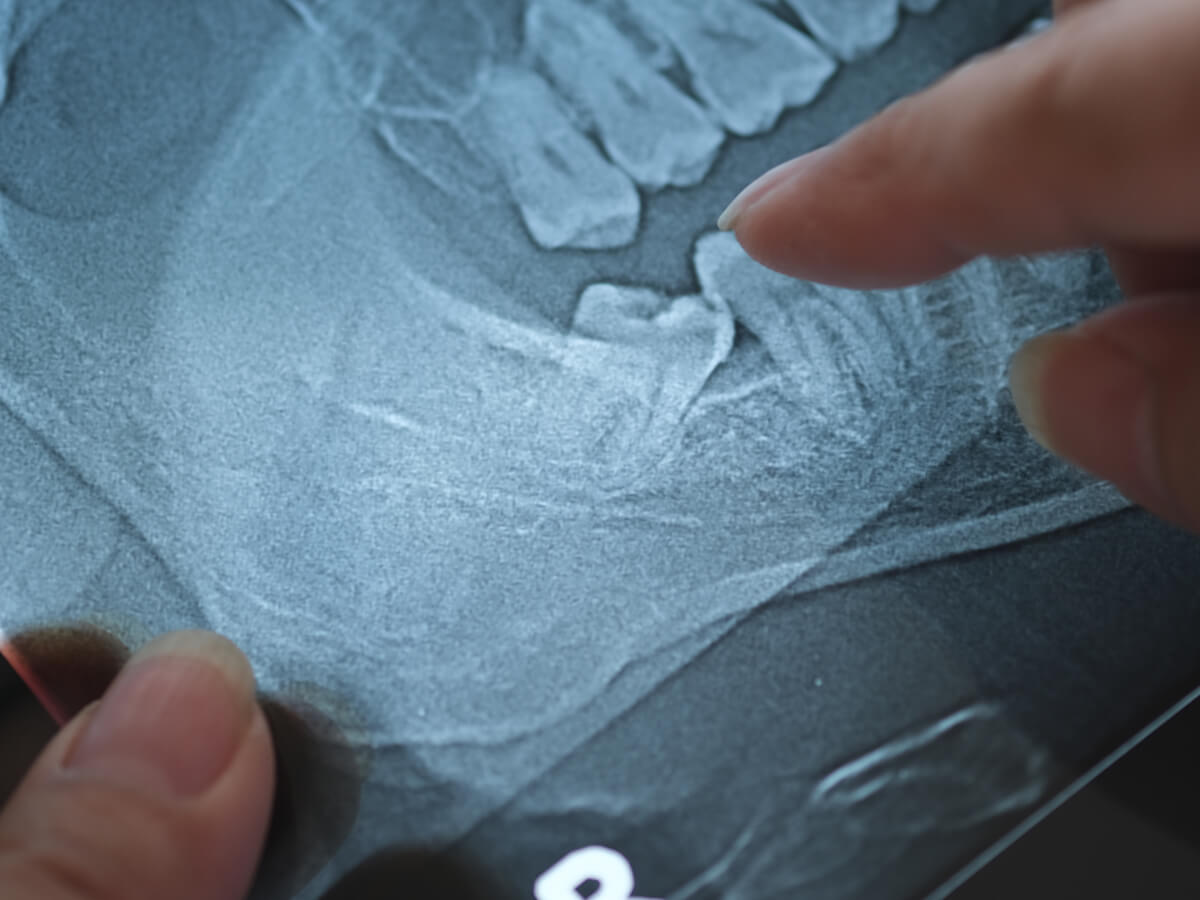 Wisdom-Tooth-Extraction-A-Step-by-Step-Guide-to-the-Procedure-and-Recovery